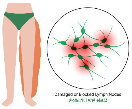 손상되거나 막힌 림프절로 한쪽 다리에 부종이 생긴 모습